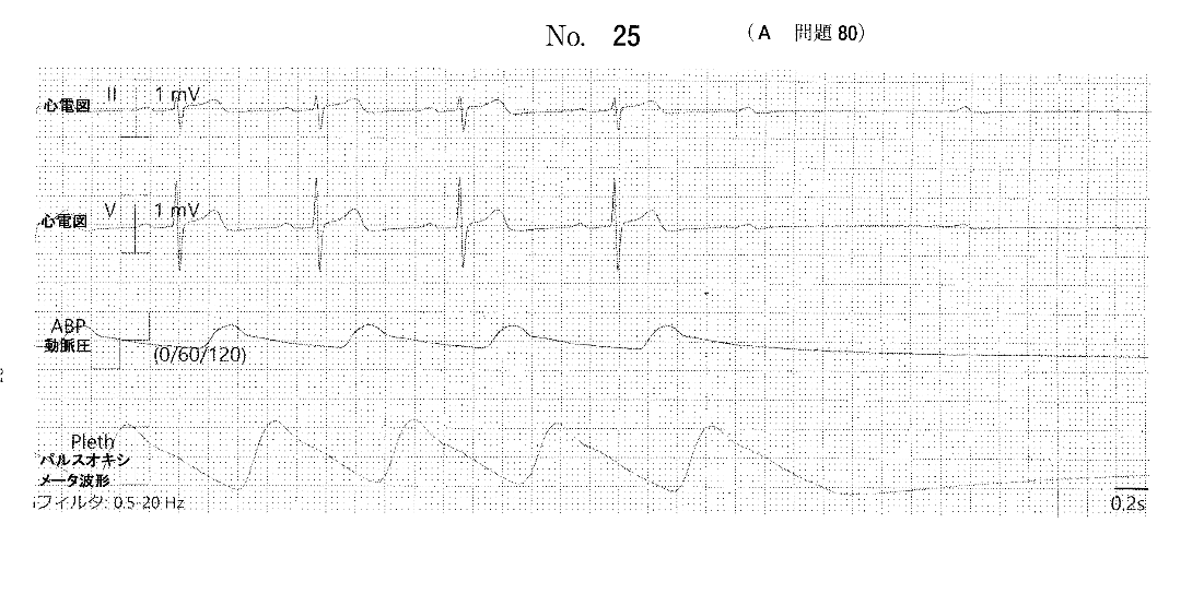 111a80ECG.png