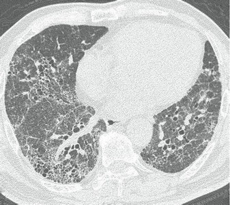 拘束 性 肺 疾患