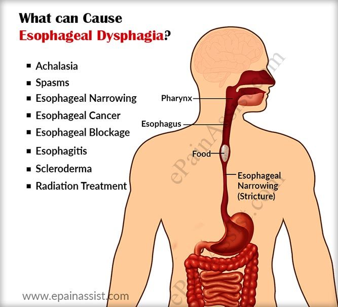 what-can-cause-esophageal-dysphagia.jpg