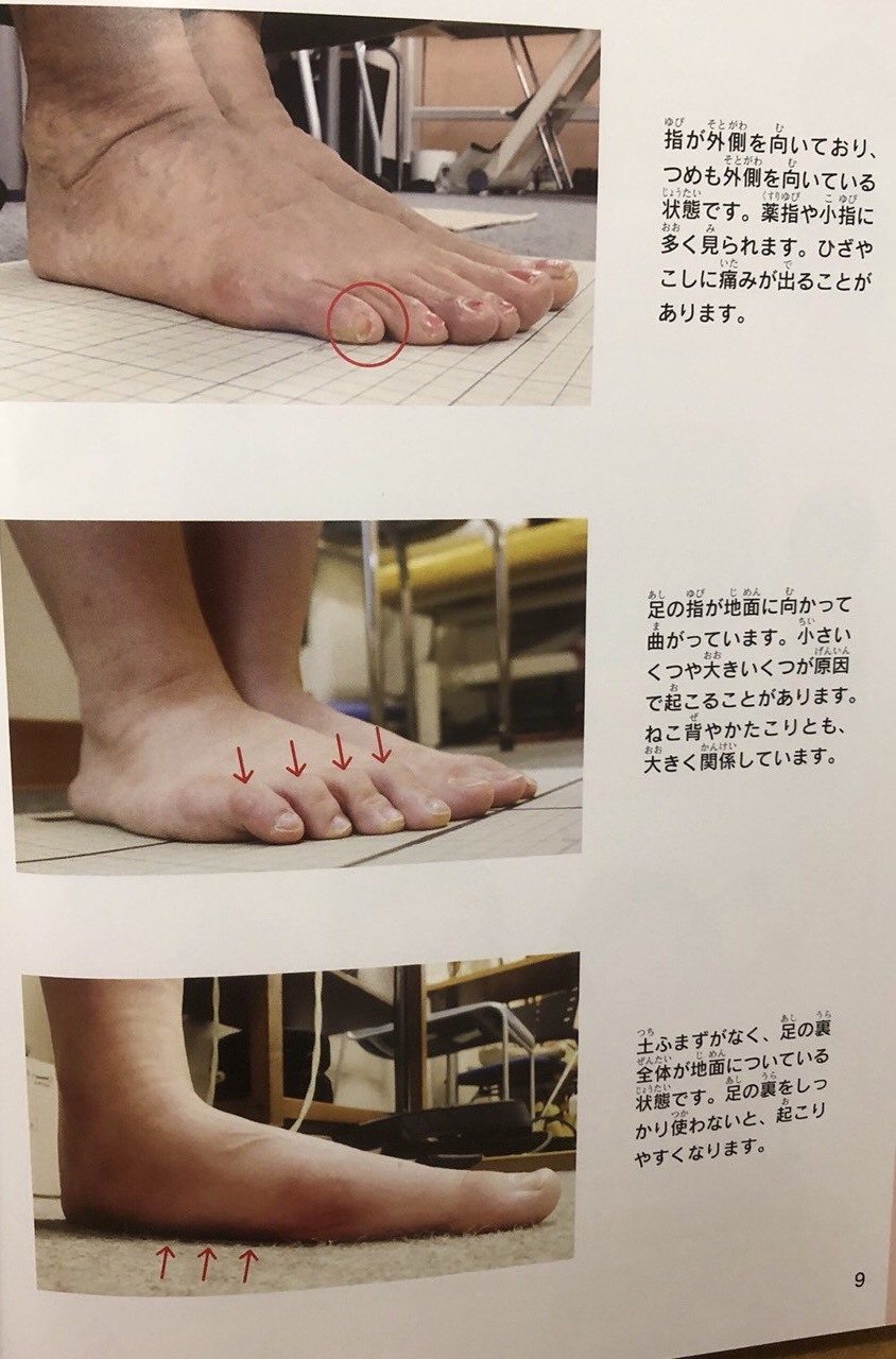 パパママ整体師入門ブログ 自宅で治そう 主な足の指のトラブル